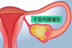 科普子宫内膜增生，可能影响试管成功率