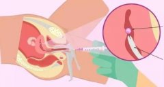 试管移植多少天可以知道成功了(7-14天内)