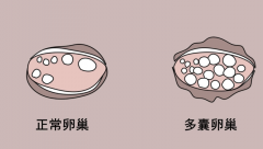 多囊卵巢能做试管吗？成功率并不低！