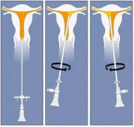 试管移植前为何要做宫腔镜检查？三大重要作用不可不知！