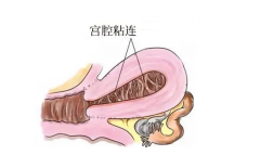 盆腔粘连不能怀孕？试管能帮助你！