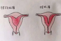 做完纵隔子宫手术能做试管吗？需参考这几点！