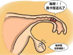 试管移植后为什么出血？异位妊娠是一种原因