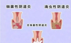 阴道炎患者能做试管吗？如何预防试管阴道炎？