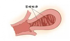 宫腔粘连影响试管吗？答案可能跟你想象的不一样！