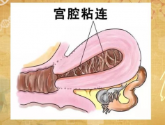 患者分享！宫腔粘连手术后也能成功做试管！