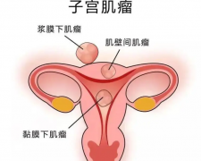 子宫肌瘤患者可以选择试管，有希望能怀孕当妈