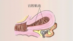 宫腔粘连患者不能随意做试管，先看看自己符合条件吗？