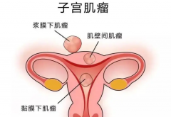 子宫小肌瘤对试管有影响吗？应该怎么治疗？