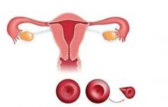 子宫内膜异位症可以做试管，这几个问题需要特别注意！