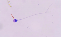 患有圆头精子症能做试管吗？成功率有多高？