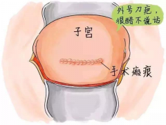 瘢痕子宫能做试管吗？剖腹产后多久可以做试管？