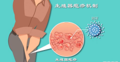 生殖疱疹不一定会影响试管手术，不需要过度担心