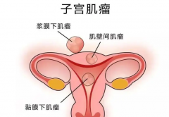 备孕体检查出子宫肌瘤怎么办，还能怀孕吗？