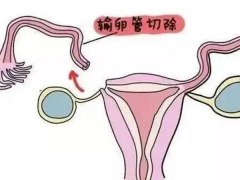 输卵管切除可以做试管，看下成功率有多少