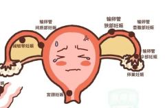 发生宫外孕还能做试管吗？有没有风险？