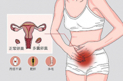 马来西亚试管为何成为多囊卵巢女性的首选？详细流程与成功率解读！