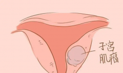 子宫肌瘤也能做试管，成功率有多少赶紧了解下！