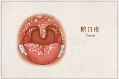 科普婴儿口腔溃疡和鹅口疮，两种病并不一样！