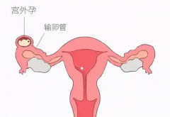 胚胎移植后出现这些症状，需警惕可能是宫外孕！
