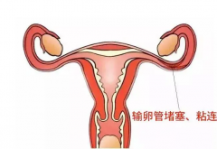 什么是输卵管性不孕？做试管成功率有多少？
