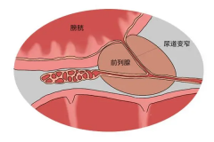 前列腺炎能做试管吗？有什么影响一看便知！
