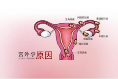 试管也可能发生宫外孕，通常由这几个原因引起！