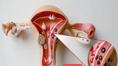 子宫腺肌症试管流程是什么？成功率有多少？