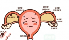 试管也可能出现宫外孕，怎么预防看这里！