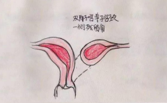 20+女性患有残角子宫，做试管怀孕几率高吗？