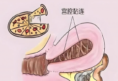 科普导致宫腔粘连的原因，女性要注意预防！