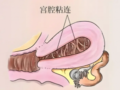 中度宫腔粘连做试管也有成功的，盘点影响二代试管因素！