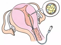 患盆腔结核想做试管？先了解这些关键信息
