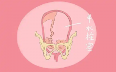孕妇为什么会产生羊水栓塞？羊水栓塞有哪些并发症？