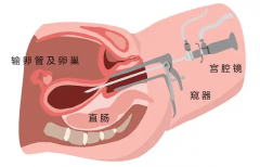 宫腔粘连的症状是什么？对女性怀孕生子有什么影响？