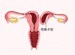 20多岁女性有残角子宫，还有希望怀孕吗？