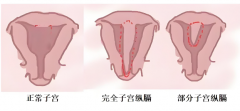 纵隔子宫做试管，着床成功率会受影响吗？详解在此！