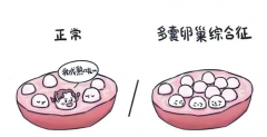 多囊卵巢综合症患者能否进行试管？全面解析在此！