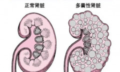 成都多囊肾试管全攻略：医院、费用、成功率一次看懂！