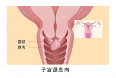 西安宫颈息肉患者试管治疗全流程，一看就懂！