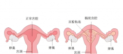 海南宫腔粘连能做试管的医院有哪些？附成功率与费用参考！