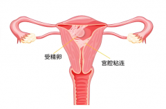 宫腔粘连手术什么时候做最好？试管前必看攻略！