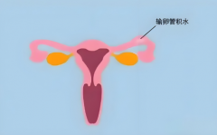 输卵管积水能做试管吗？成功率和适宜条件全解析！
